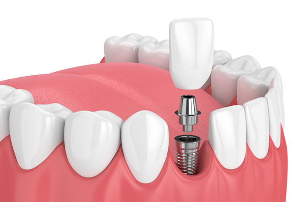 Rendering of jaw with dental implant at Dental Care of Burlington in Burlington, MA