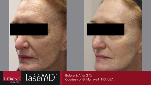 Skin before and after LaseMD treatment