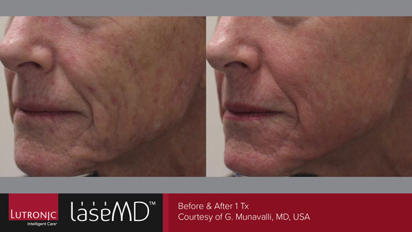 Skin before and after LaseMD treatment
