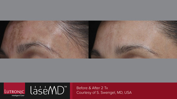 Skin before and after LaseMD treatment