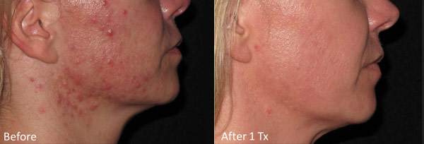 Skin before and after Micro-needling treatment