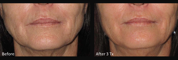 Skin before and after Micro-needling treatment