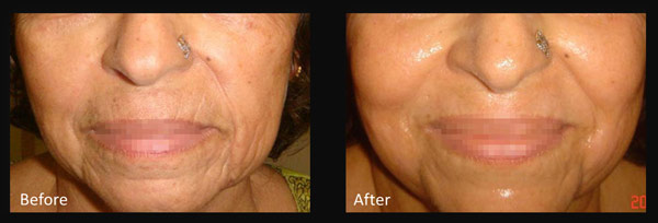 Skin before and after Micro-needling treatment
