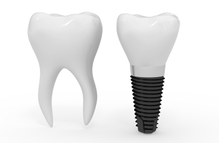 An example of a dental implant and a molar at Dental Care of Burlington in Burlington, MA.