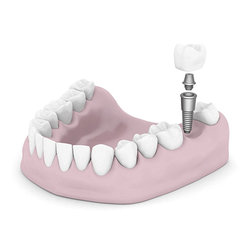 A 3D rendering of a single dental implant A 3D rendering of a single dental implant
