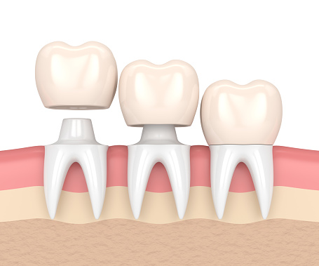 Diagram image of dental crowns, at Dental Care of Burlington in Burlington, MA.