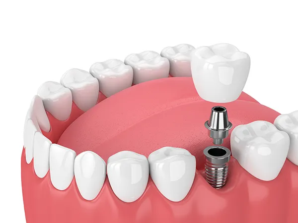 Diagram image of a dental implant being placed, at Dental Care of Burlington in Burlington, MA.