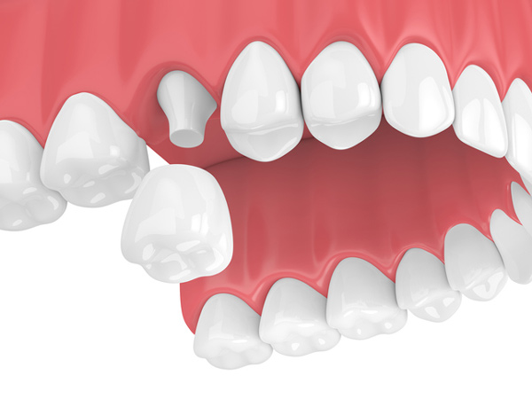 Rendering of jaw with dental crown at Dental Care of Burlington in Burlington, MA