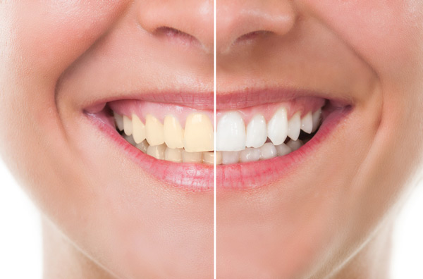 Before and after photo of Zoom teeth whitening treatment at Dental Care of Burlington in Burlington, MA
