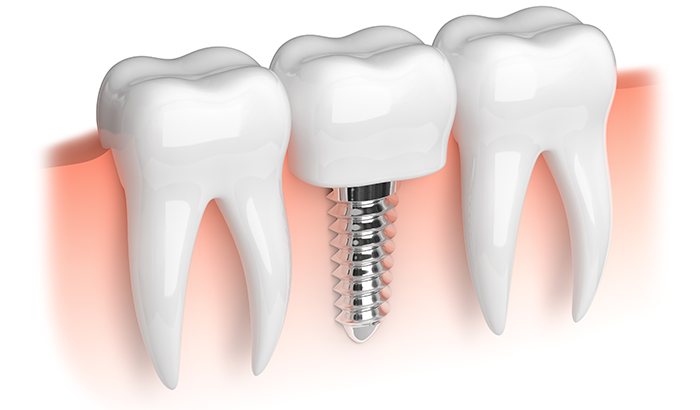 Image of a dental implant at Dental Care of Burlington in Burlington, MA.