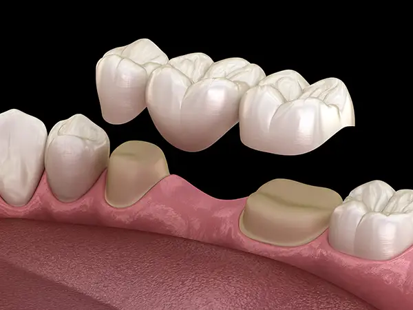 A dental bridge being placed over prepared teeth in the lower jaw that are separated by a gap.