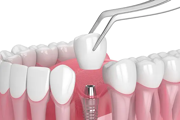 Close-up of a dental implant with crown being placed on the implant, illustrating the final stage of dental implant installation.