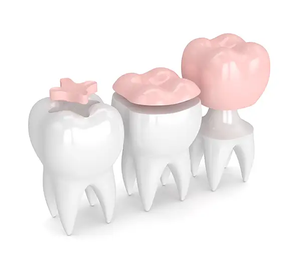 Three teeth, one each with inlays, onlays, and crowns, highlighting different restorative dentistry options.