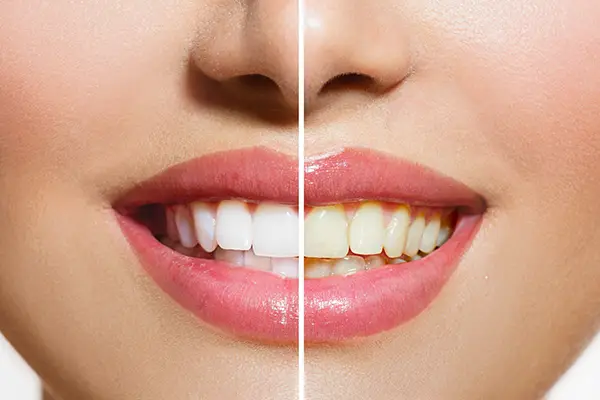 A woman's smile, before and after her professional teeth whitening treatment.